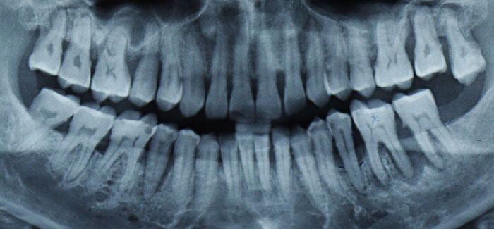 periodontal xray