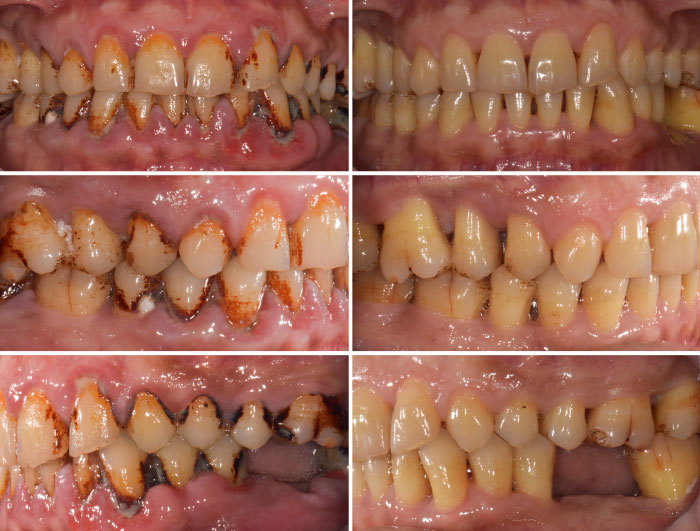 case-study-1-Generalised-Moderate-Advanced-Chronic-Periodontitis case study 1