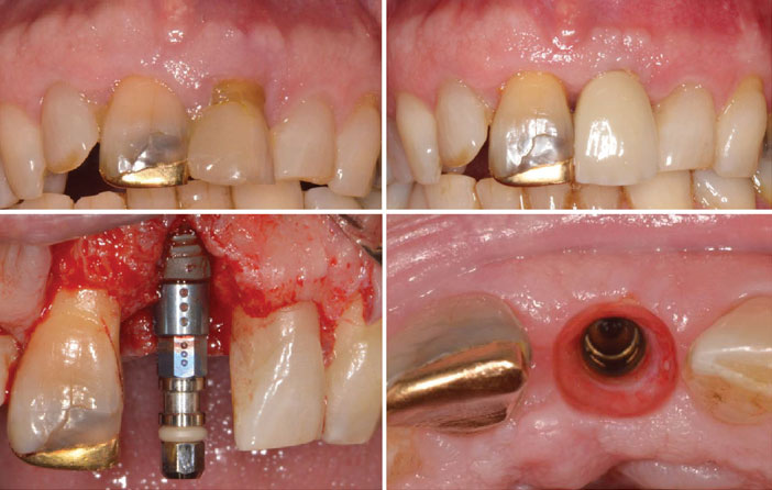 case-study-3-Implant-Surgery-in-the-Aesthetic-Zone-1