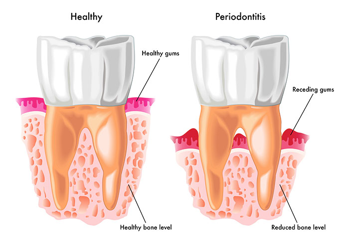 strategy forex lungo periodontal disease