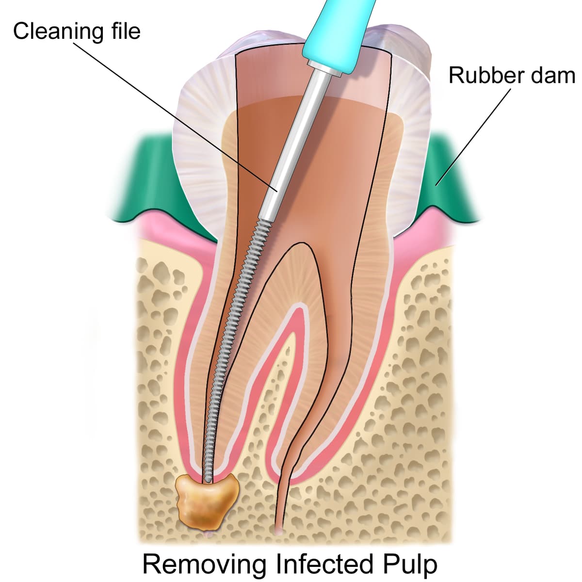 the root canal treatment process